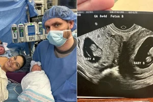Hiếm gặp thai phụ có tử cung đôi, sinh 2 bé gái vào 2 ngày khác nhau