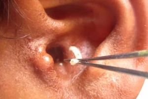 Hàng trăm con giòi ‘ăn thịt người’ làm ổ trong tai