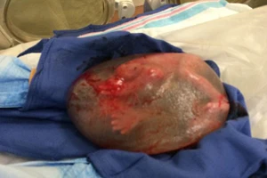 Kinh ngạc: Em bé chào đời trong.... túi ối