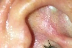 Sốc khi phát hiện trong tai có... nhện