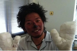 Quyết chinh phục 'nóc nhà thế giới' dù chỉ còn một ngón tay