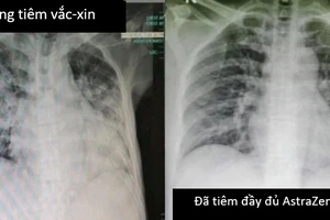 Chuyên gia: Cần rút ngắn khoảng cách giữa 2 mũi vaccine Astrazeneca ở 'vùng đỏ'