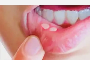 Một số thực phẩm và biện pháp giúp khắc phục vết loét miệng tại nhà hiệu quả