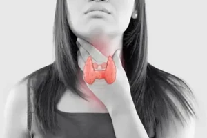 5 chất dinh dưỡng quan trọng mà bệnh nhân tuyến giáp cần có trong chế độ ăn uống