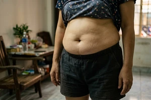 3 loại thực phẩm gây mỡ bụng cần tránh để kiểm soát cân nặng