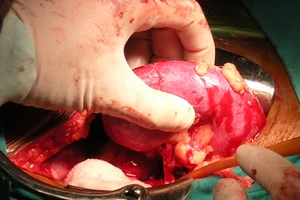 'Hiến' thận lấy 100 triệu để cứu gia đình thoát nợ