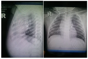 Gắp thành công dị vật kim loại trong khí quản bé 20 tháng tuổi