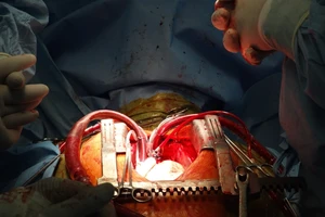 Ghép tim nhân tạo đầu tiên tại Việt Nam