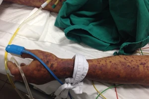 Sốc: Bị hoại tử mặt, tử vong vì ăn tiết canh lợn dính liên cầu khuẩn 