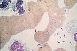 Nguy cơ lây lan dịch hạch vào Việt Nam rất lớn