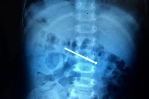 Được bố cho chơi, bé trai 18 tháng tuổi nuốt luôn... cây đinh 