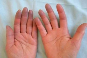 8 nguyên nhân khiến tay chân bạn lúc nào cũng lạnh