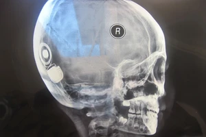 Khánh Hòa: Lần đầu tiên cấy ghép ốc tai điện tử thành công