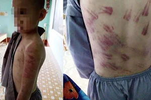 Sự thật bé trai mồ côi bị sư cô đánh tím khắp người