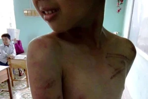 Sư chùa dùng đòn roi đánh bé trai bầm tím cơ thể