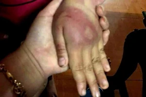 Bé gái 8 tuổi bị bố đánh đập dã man, mẹ xin miễn hình sự