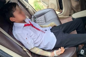 Nổ bóng bay trong lễ khai giảng, 7 học sinh Thanh Hóa bị bỏng tay