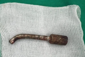  Phẫu thuật rút mũi khoan đá đâm xuyên hốc mũi bệnh nhân