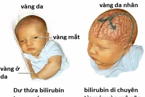 Bệnh vàng da nhân não ở trẻ sơ sinh, nếu để muộn, sẽ gây nguy hiểm tới tính mạng của trẻ.