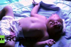 Em bé sơ sinh có hai khuôn mặt