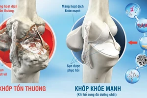 Coi chừng viêm khớp tự miễn hậu COVID-19