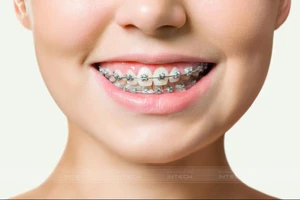 Niềng răng bao lâu siết một lần? Có bị hóp má khi niềng không?