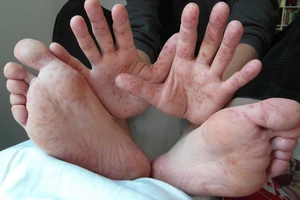 3 ca tử vong vì tay chân miệng, Bộ Y tế ra công văn khẩn 