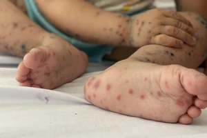 Đẩy nhanh cấp phép lưu hành vaccine tay chân miệng nhập khẩu