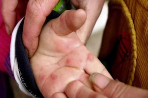 Biết gì về ‘cúm cà chua’ hiếm gặp đang hoành hành ở Ấn Độ? 