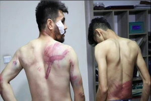 Hai phóng viên tờ Etilaat Roz của Afghanistan có nhiều lằn đỏ ở nhiều nơi trên cơ thể. Ảnh: REUTERS