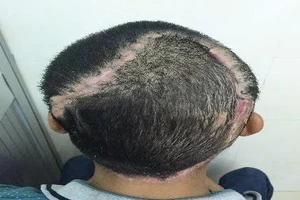 Cấy tóc cho bệnh nhân bị… lộ xương sọ