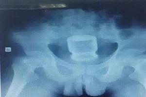 Dùng lọ nước yến thông hậu môn để trị… táo bón