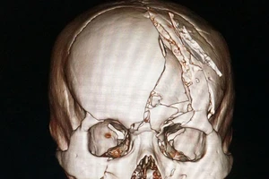 Cứu sống nạn nhân sọ vỡ nát nhiều mảnh