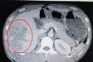 Bơm xe tải, bánh xe nổ ép vỡ gan một thanh niên