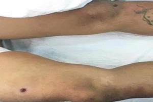 Thanh niên 'ngáo đá' bị bắn đạn cao su thủng đùi