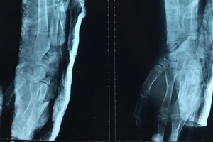 Cứu bệnh nhi bị chân vịt ghe chém gãy xương cánh tay 