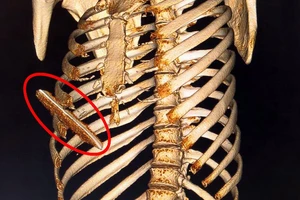 Cứu sống bệnh nhân suýt tử vong do dao đâm thủng gan