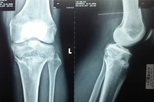 Cứu bàn chân suýt bị cưa của anh xe ôm