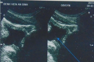 Tự lấy sỏi thận qua đường niệu bằng… cọng cỏ