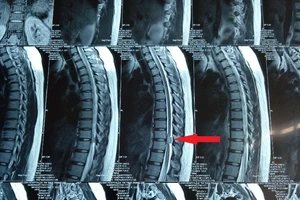 Phẫu thuật thành công cho bệnh nhân u tủy sống ngực