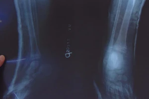 Rách da, gãy gót do kẹt chân vào căm xe máy