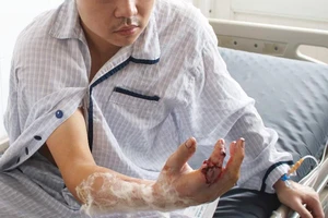 Sơ suất, thanh niên bị máy xay thịt cắt lìa ngón tay