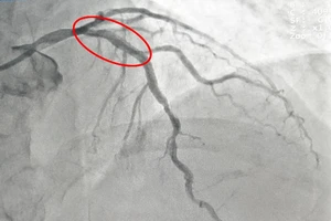 Bị nhồi máu cơ tim cấp khi đang uống bia