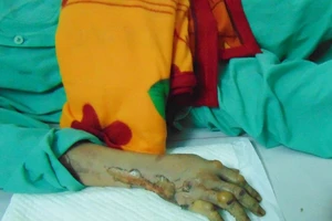 Hai mẹ con bị bỏng trong vụ cháy