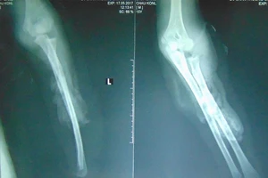 Hơi nóng máy ép keo đốt cháy tay bệnh nhân Khmer