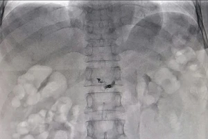 Tưởng đâu đau dạ dày, té ra mắc bệnh hiếm