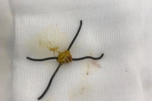 Hai cọng kẽm đâm thủng 5 lỗ trong ruột non