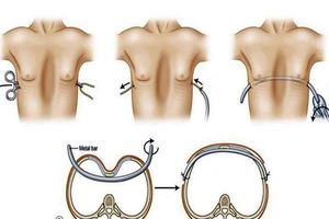Bảo hiểm y tế chăm lo “vòng một” cho trẻ bị lõm ngực 