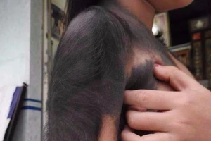 Cơ hội chữa bệnh miễn phí cho bé gái 'người sói' 