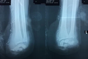 Một tay đứt lìa, một tay lủng lẳng do bị chém